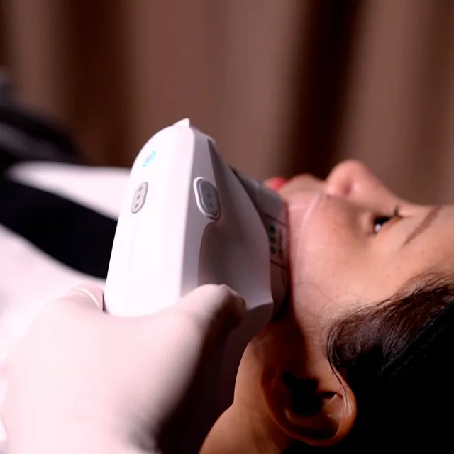 Ultherapy Prime treatment step 3