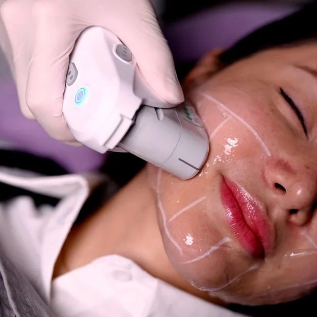 Ultherapy Prime treatment step 4