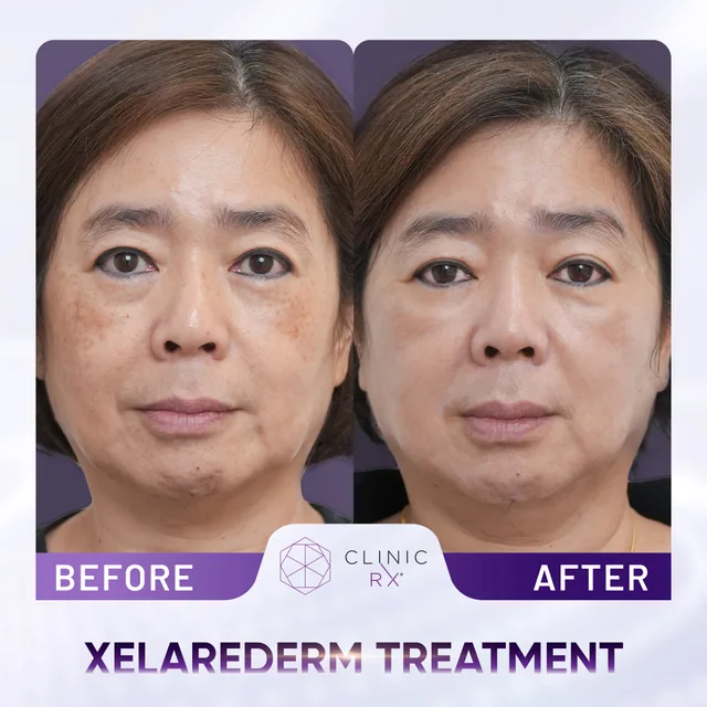 XelaRederm actual result 1
